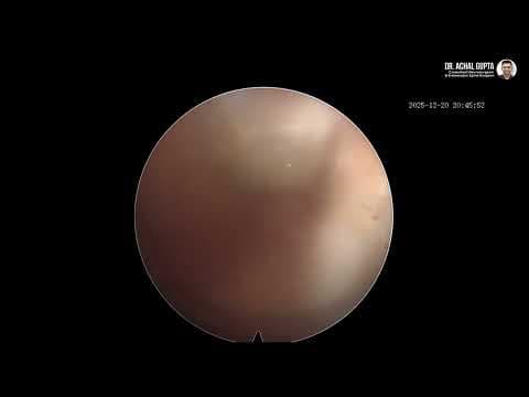 Dr. Achal Performs PSLD for Sciatica | She Couldn't Walk Due to Severe Leg Pain